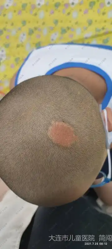 儿童院区烧伤整形科194人已读评论赞案例案例皮脂腺痣治疗前患者头皮