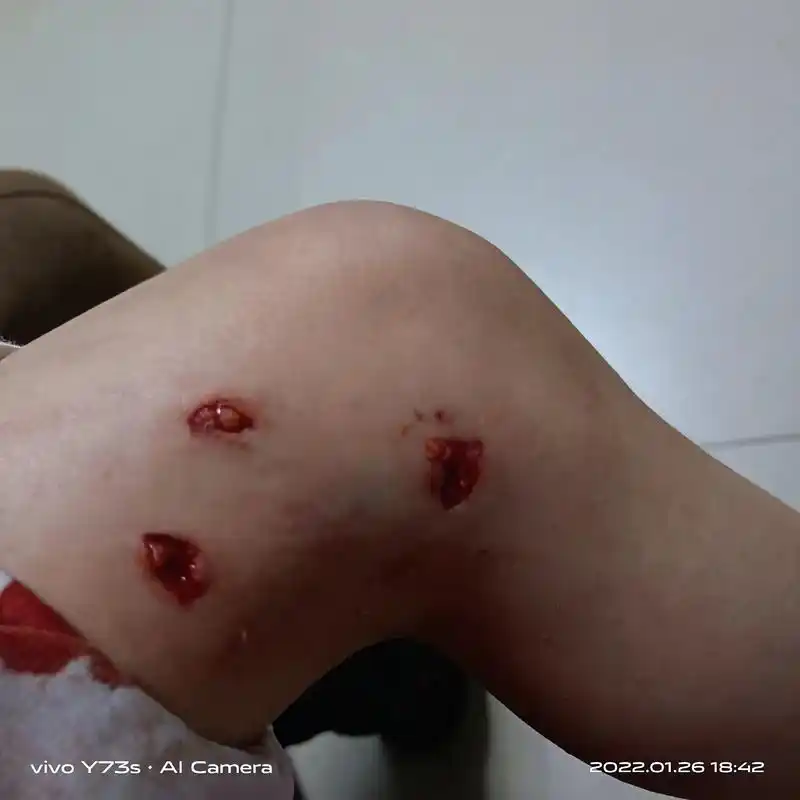 生活碎片记录 一个月了伤口愈合了,被狗咬的时候心都是揪着的 - 抖音