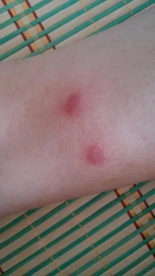 请教一下腿上长的这些红疹到底是啥,去医院看,各种说法,过敏,湿气