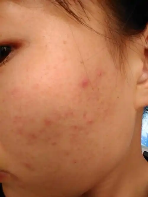 痘痘起很长时间了,大小不一,有的发红,里面有很多脏东西,痘印