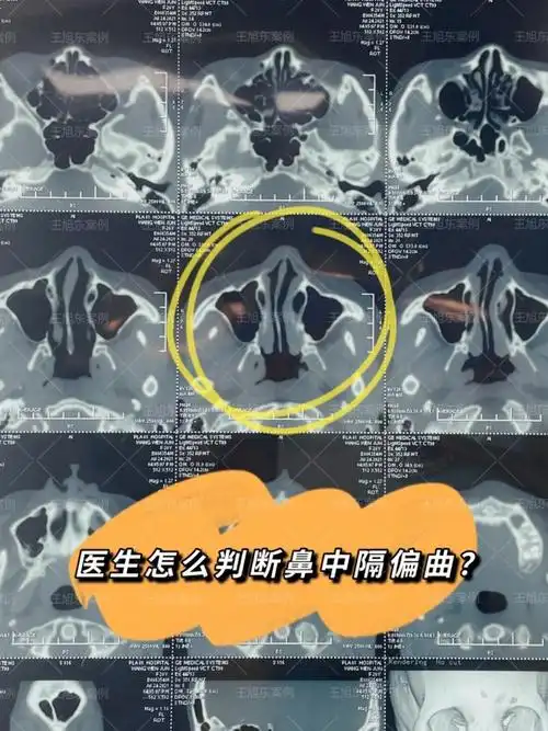 鼻中隔偏曲矫正指南