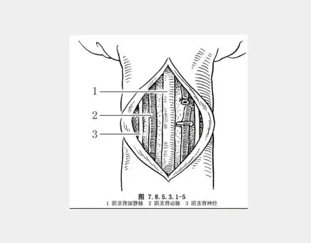 传统阴茎背神经阻断术是一种通过切断部分阴茎神经来降低龟头敏感度的