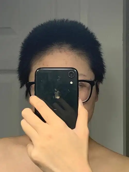 光头蓄发2个月整米诺地尔反馈尴尬期开始