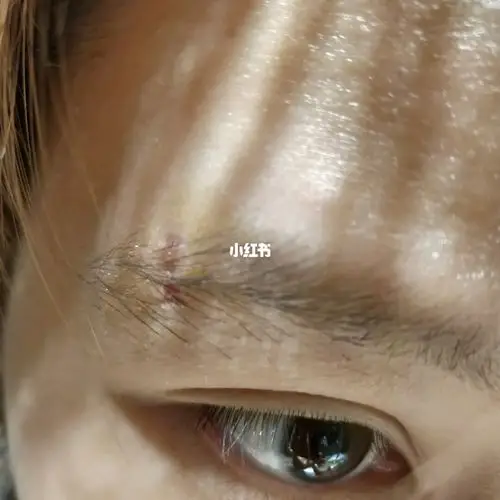 有自己穿过眉钉的吗,原眉钉豁口