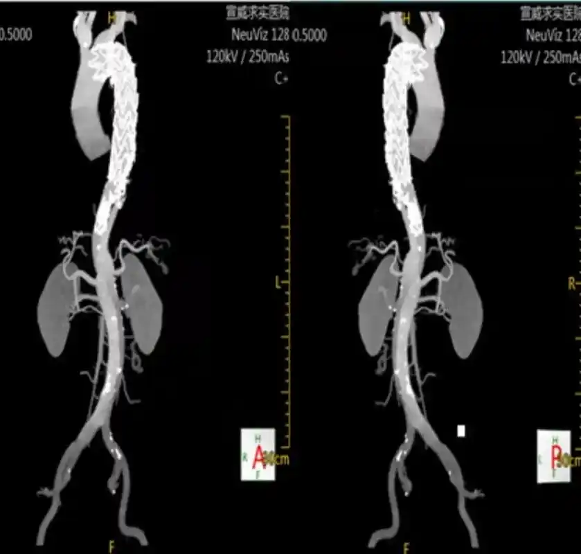 胸主动脉支架术后主动脉夹层一例图片