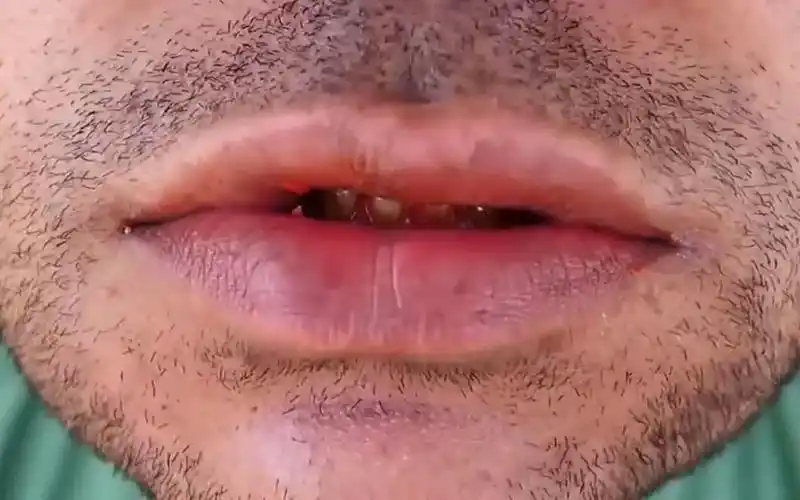 槟榔到底有多可怕,槟榔王国中的割脸人