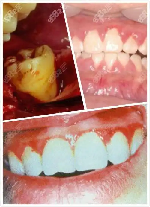 牙龈炎早期和晚期图片及症状图片是什么样子呢?