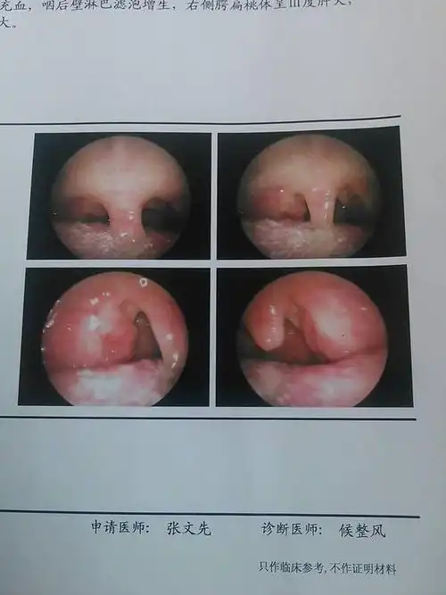 悬雍垂肿大图片,悬雍垂发炎图片红肿-图片大观-奇异网