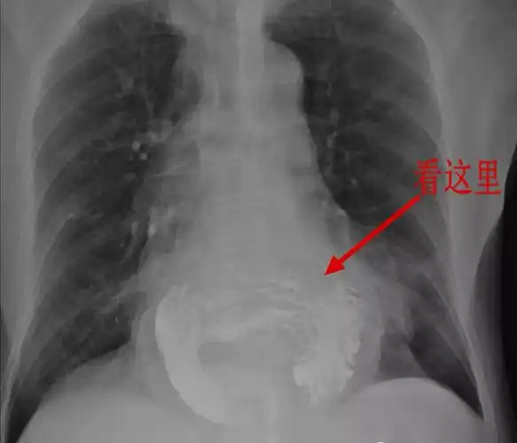 经典影像之食管裂孔疝 - 好大夫在线