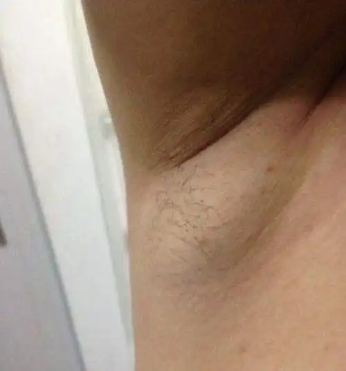 接种卡介苗竟然引发腋下淋巴肿大结核肿瘤_有来医生