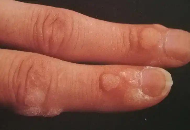 病毒疣之寻常疣兄弟姐妹篇 - 好大夫在线