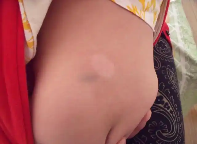 无色素痣 的表现及与白癜风和贫血痣的区别