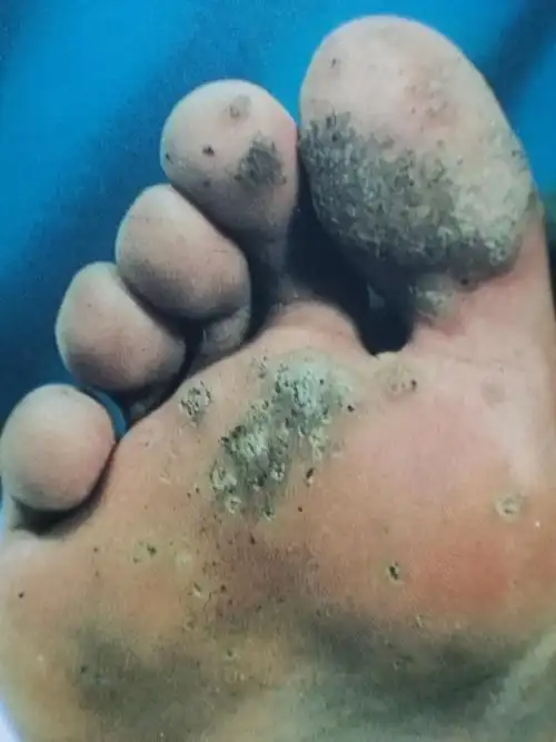 病毒疣之寻常疣兄弟姐妹篇 - 好大夫在线