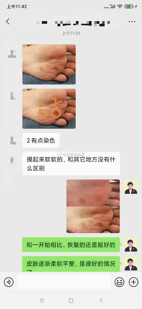 跖疣##孙叔公##健康##618万物狂欢节