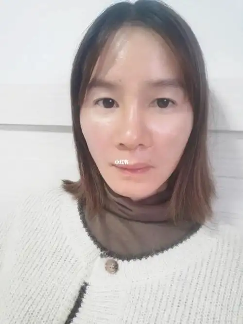 线雕鼻底基第二天隆鼻第第九天