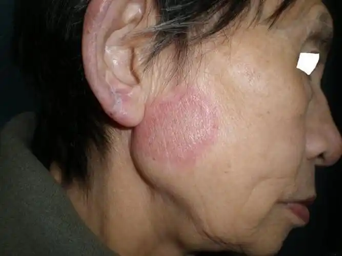 面部盘状红斑狼疮图片