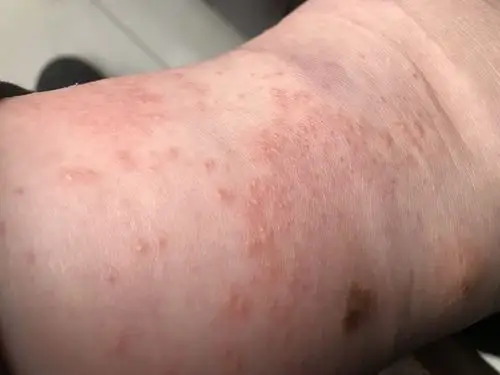 我腿上起的是热疙瘩 还是湿疹