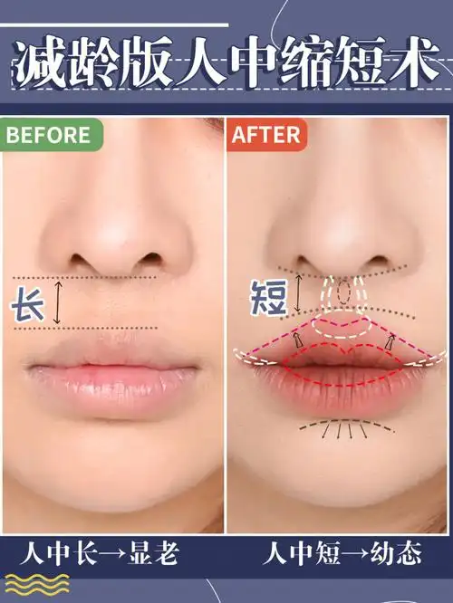人中长度会影响面中长度,人中短显得面中短,可爱减龄,更有亲和力,人也