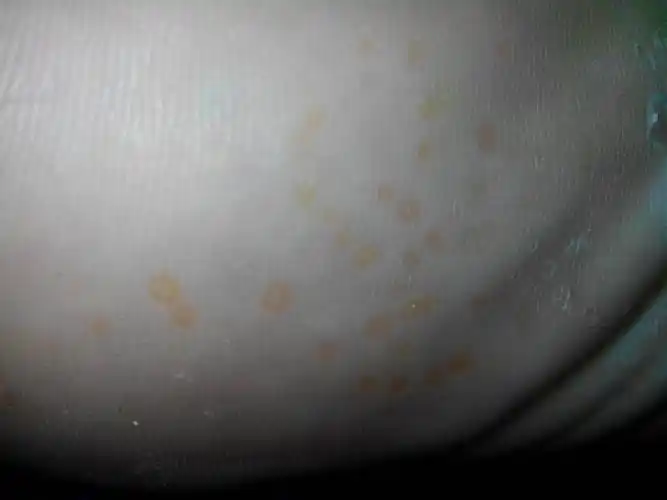 了刚刚换鞋子忽然发现鞋底长了一片黄色小圆点切脚底皮肤被水泡的有些