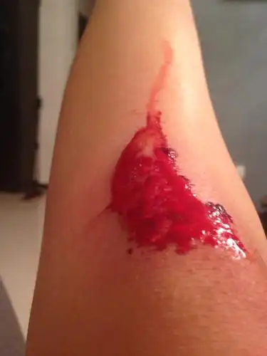 问:腿破了,咋办?谢谢了