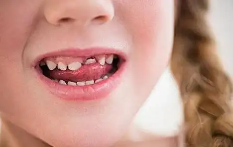 儿童口腔保健七大误区,90%妈妈都不知道!