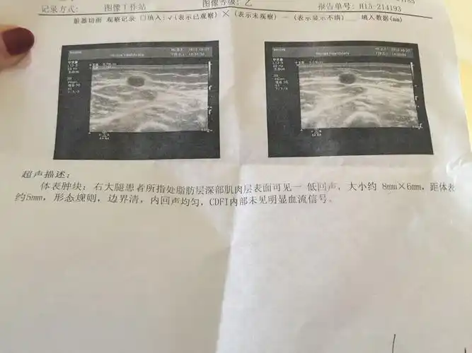 女生 大腿总是阵痛 已经两三年了 一碰就痛 去医院说可能是脂肪瘤 做
