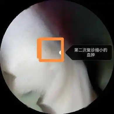 乳腺微创术后不可大意,很常发生的"血肿"一定要这样处理!