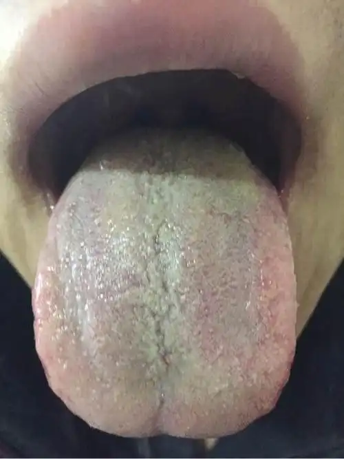 珍贵舌诊肝脾不和阴虚火旺肝郁血瘀的舌苔看完记得存