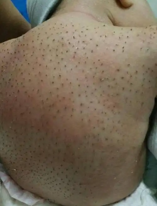 刚出生不久的婴儿身上为什么会长"黑毛"?宝妈别太担心