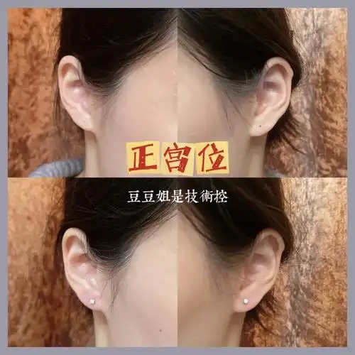 论第一对标准耳珠钉的重要性