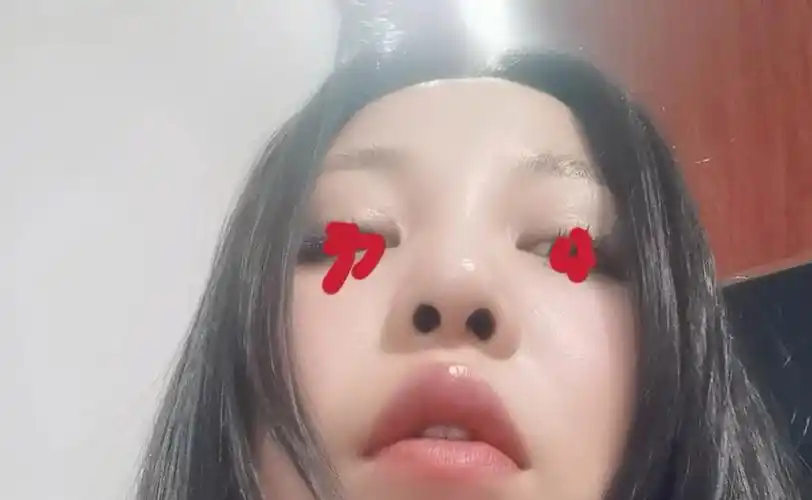 取鼻假体第十三天