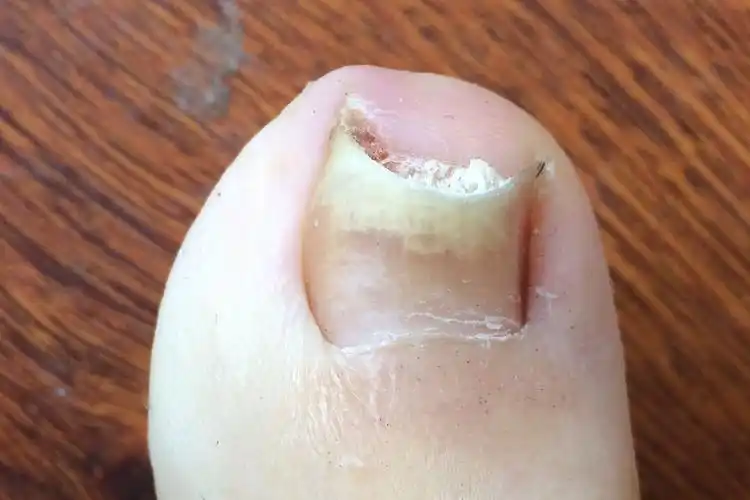 可能会出现指甲颜色的改变以外,患者可能不会伴随出现其他不适症状