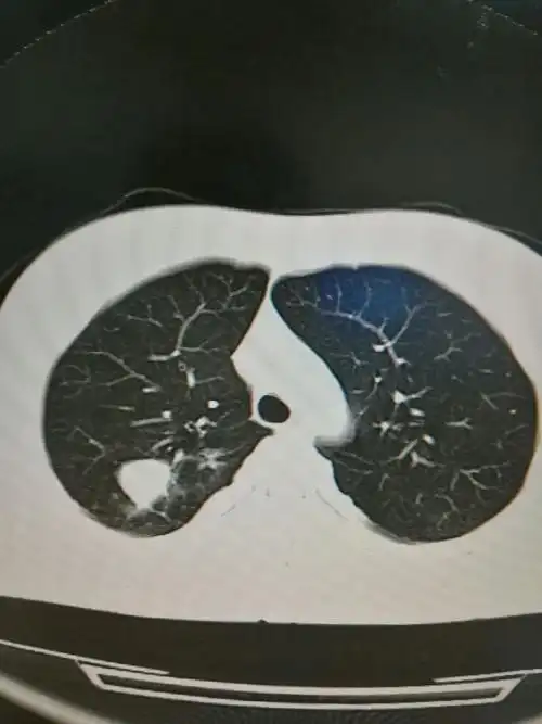 其它 结核球的相关征象及诊断 写美篇右肺上叶见类圆形混杂密度影,内