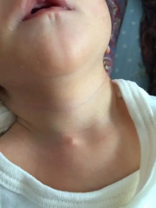 脖子上长了个米粒大小的东西,摸着是活动的,是什么东西_百度宝宝知道