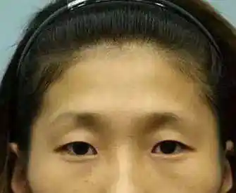 眉骨高额头凹陷面相_额头两侧凹陷面相_额头凹陷面相男人