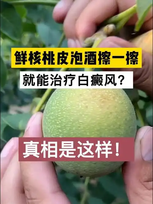 青核桃皮泡酒能治疗白癜风
