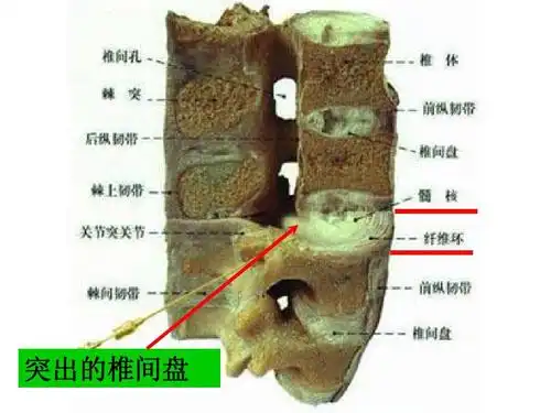 腰椎间盘突出症护理