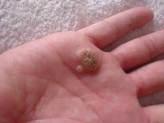 刺猴图片和症状 (104)_有来医生