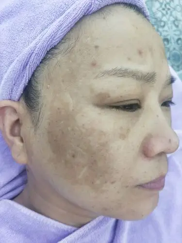 20190824胡女士祛斑,(黄褐斑,铅汞斑)