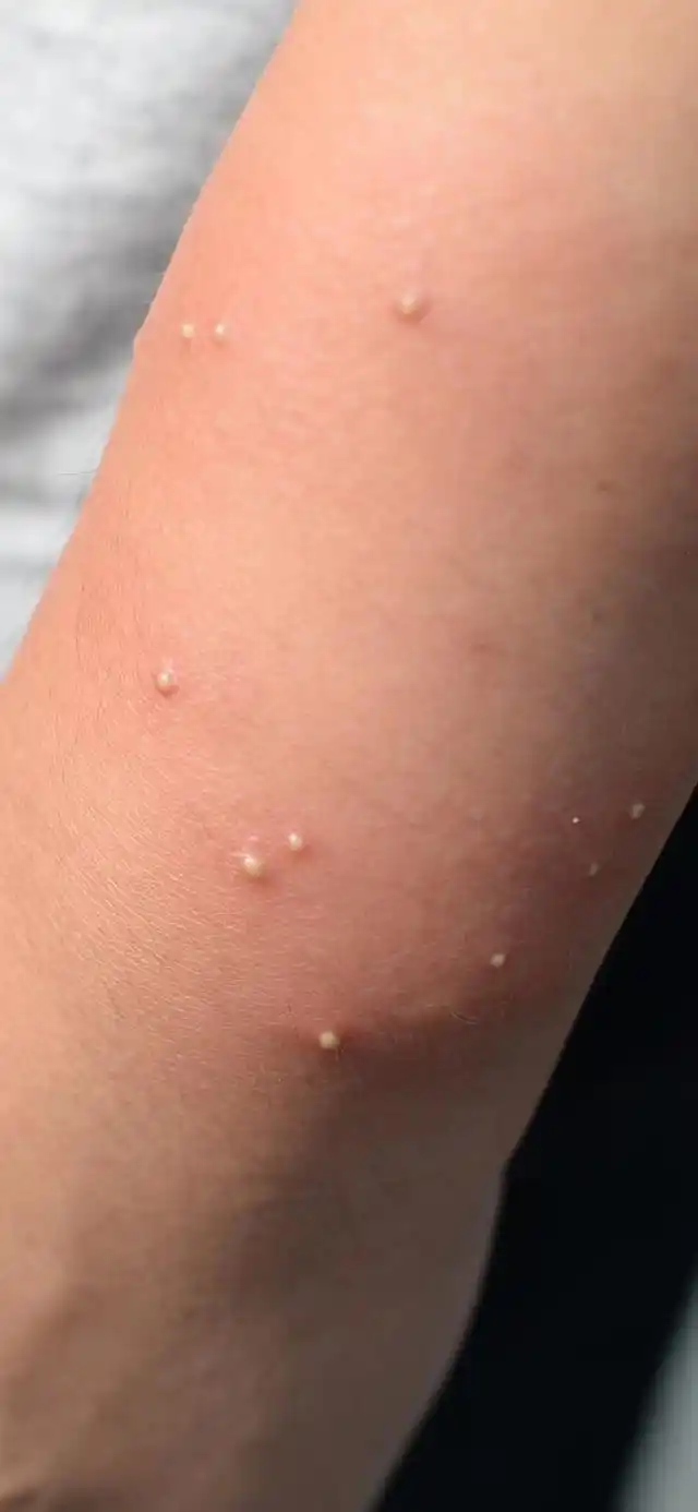 本地看点>正文>被红火蚁叮蜇后的症状羊城晚报·羊城派:我们在户外