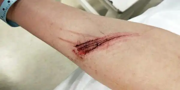 刀伤处在距离心脏2厘米处,刀伤长2厘米,深2厘米!能构成轻伤吗