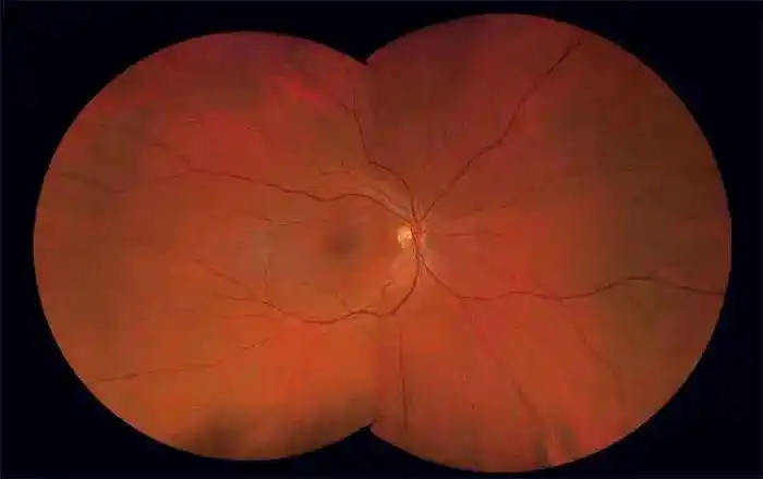 而且,蔡司clarus 500提供的真彩眼底图,就犹如临床检查中亲眼所见的