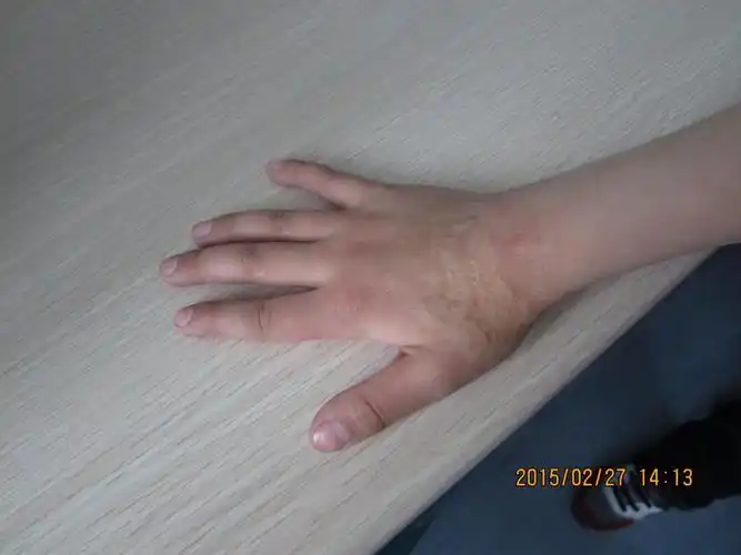 儿童手背植皮术后2年对比