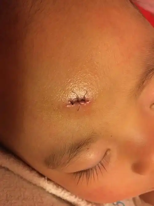 求助:儿子头摔破了,怎样才能不留疤啊.