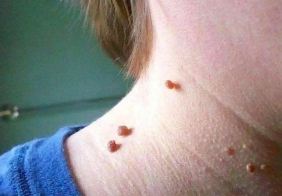 脖子上长这种病毒疣,千万别扣!别剪!