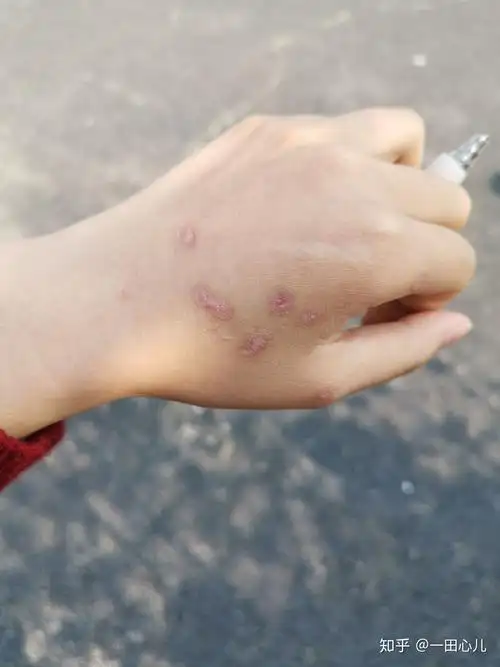 扁平疣冷冻 - 知乎