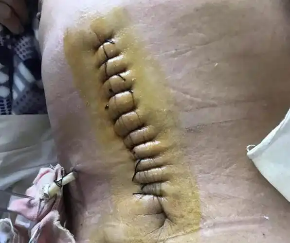 任县医院外三科完成首例腹腔镜下胃溃疡穿孔修补术