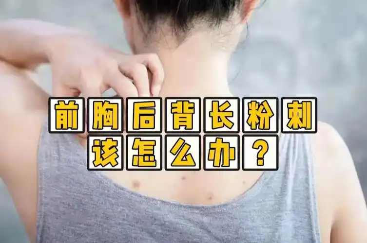 前胸后背长粉刺该怎么办
