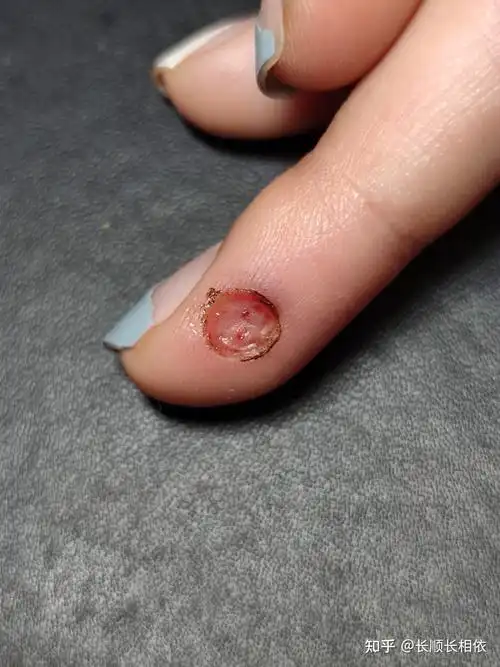 激光去除手指病毒疣记录