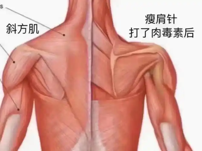 这次操作了瘦肩针项目